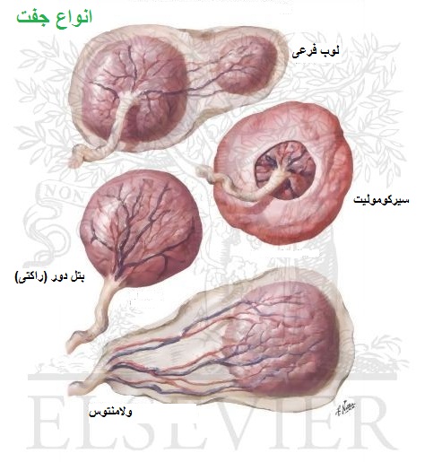 انواع مختلف جفت در بارداری (از نظر شکل)