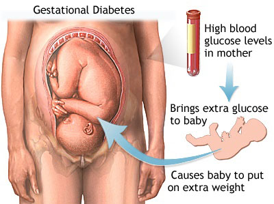 رابطه دیابت بارداری با درشت شدن جنین