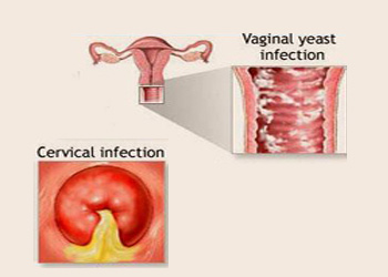 عفونت های قارچی در دوران بارداری