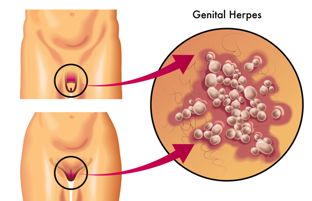 هرپس تناسلی – علائم، درمان، علل و گسترش