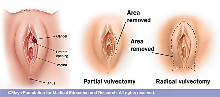 سرطان های ولوو (Vulvar Cancer)