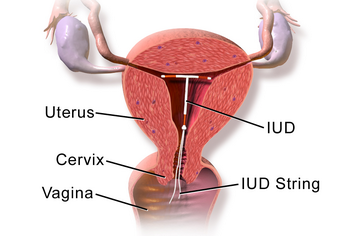 آیا حامله شدن خانم ها با وجود دستگاه IUD امکانپذیراست؟