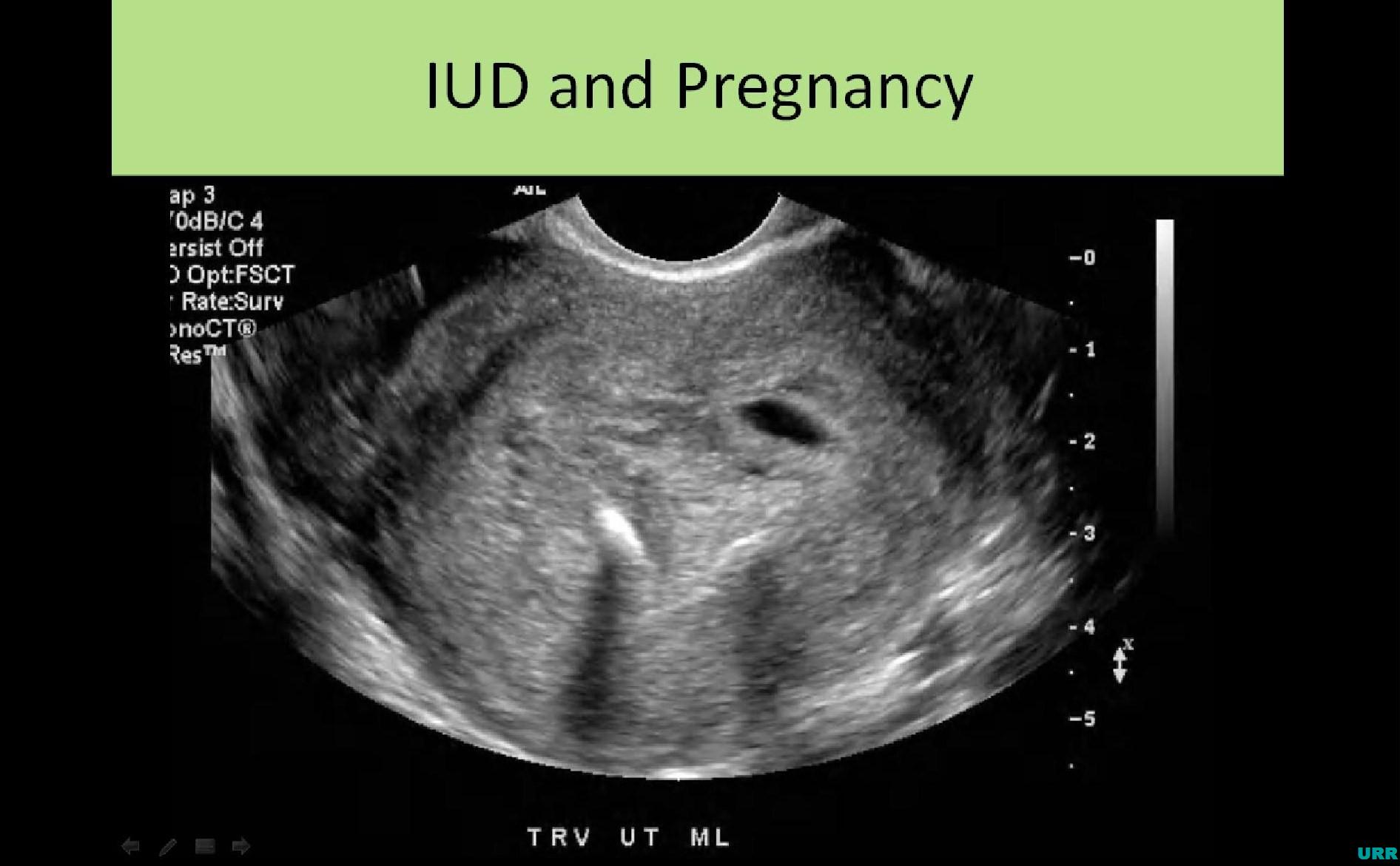احتمال حاملگی با IUD