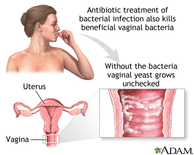 عفونت باکتریایی واژن
