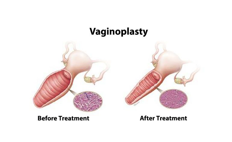جراحی زیبایی واژن (لابیاپلاستی – واژینوپلاستی- پرینورافی) 