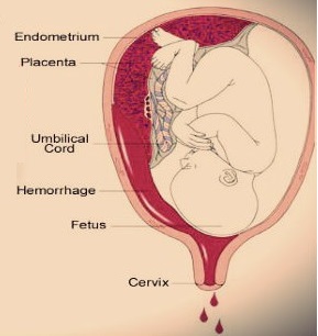 احتمال بارداری در زمان خونریزی 