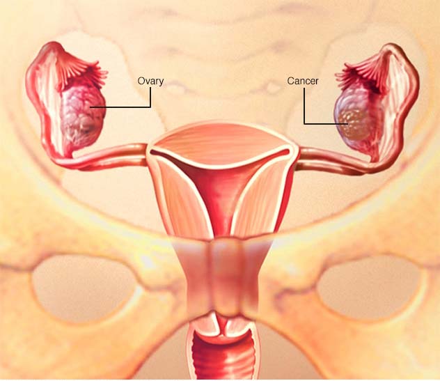 هشدارهایی به خانم ها در مورد سرطان تخمدان