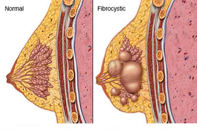 فیبروکیستیک تغییرات سینه 